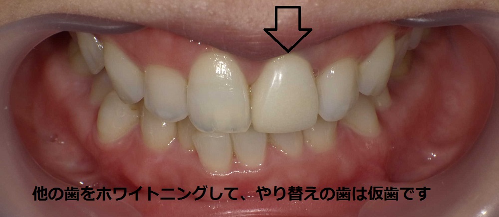 白くてキレイな歯に...♪（1）