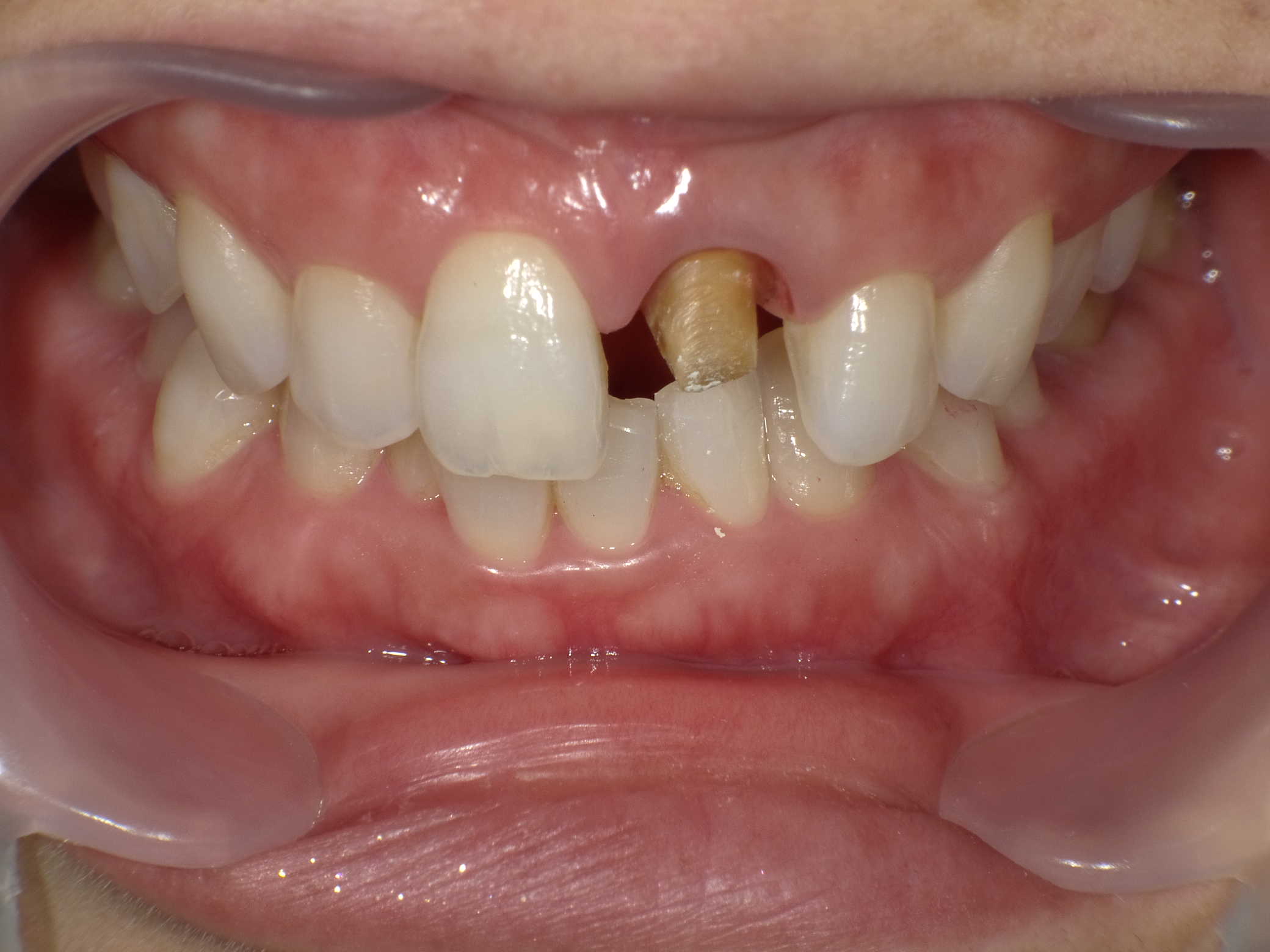 白くてきれいな歯に...♪（2）