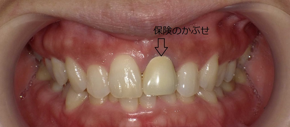 白くてきれいな歯に...♪（2）