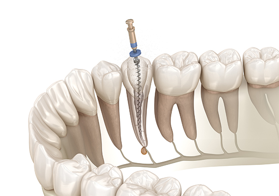 歯を抜かないための「根管治療」とは